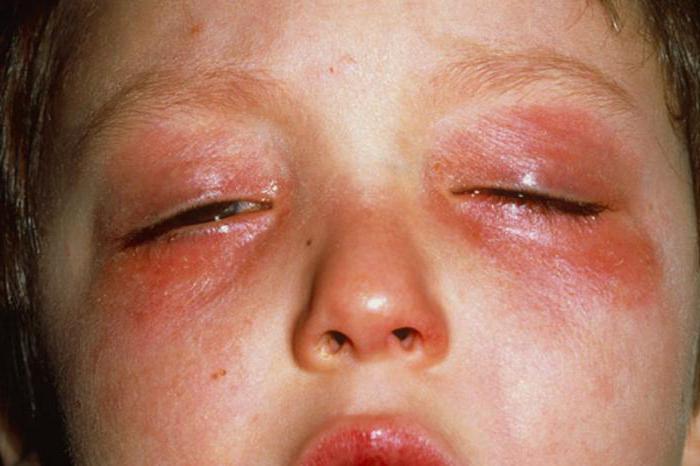 Аллергия на хлорку симптомы