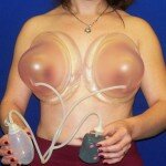 система Брава для увеличения груди
