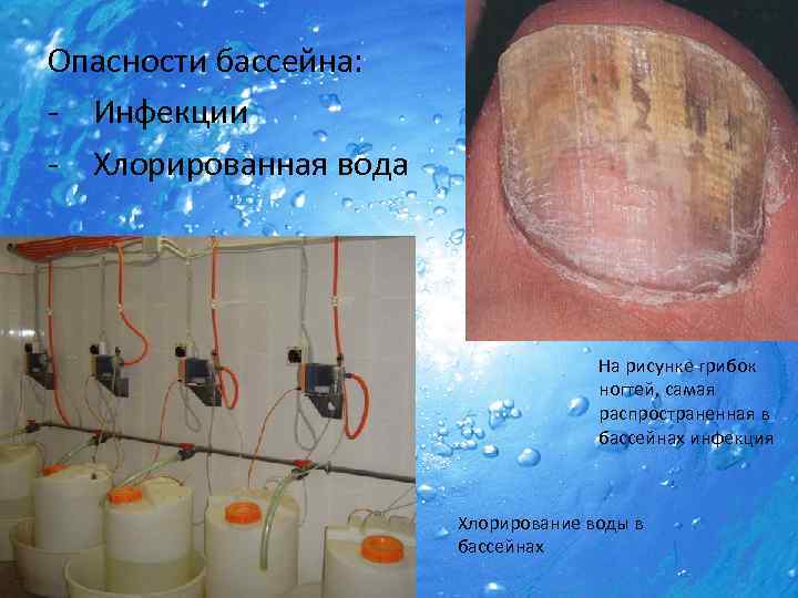 Опасности бассейна: - Инфекции - Хлорированная вода На рисунке грибок ногтей, самая распространенная в