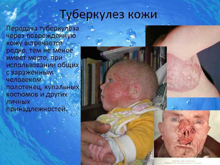 Туберкулез кожи • Передача туберкулеза через поврежденную кожу встречается редко, тем не менее имеет